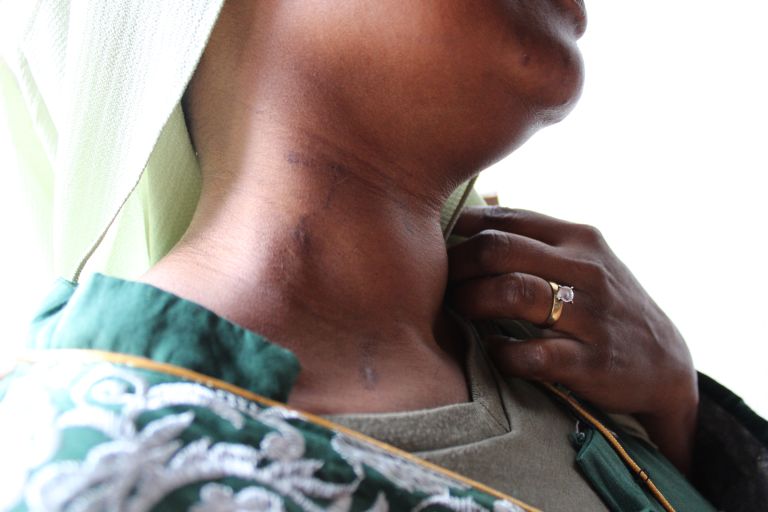 Eine Frau zeigt ihre Narben am Hals.